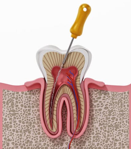 ROOT CANALS
