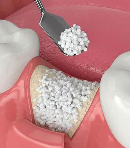 Dental illustration showing tooth cavity filling procedure with white composite material and instruments on pink background.