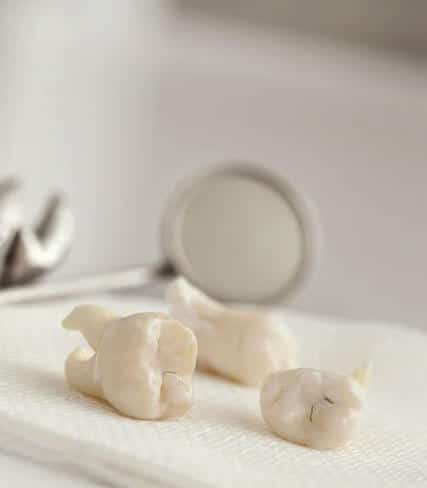 White dental models or molds displayed on a surface with a magnifying glass in the background.