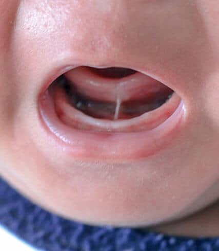 Close-up of child's open mouth showing teeth and oral cavity during dental examination.
