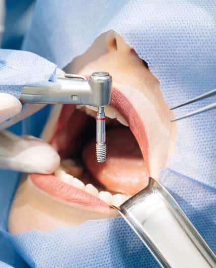 IMPLANTS