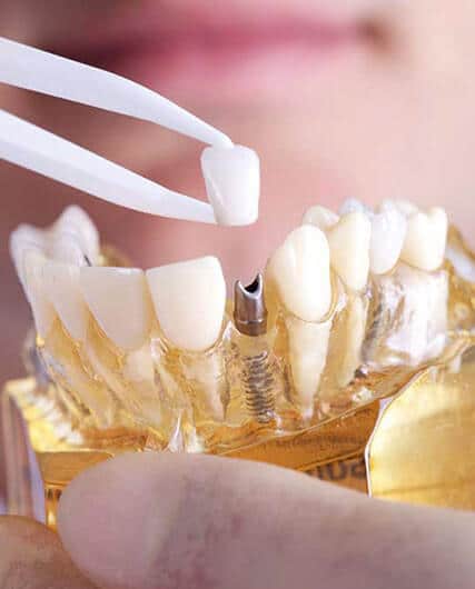 IMPLANTS(SURGICAL)