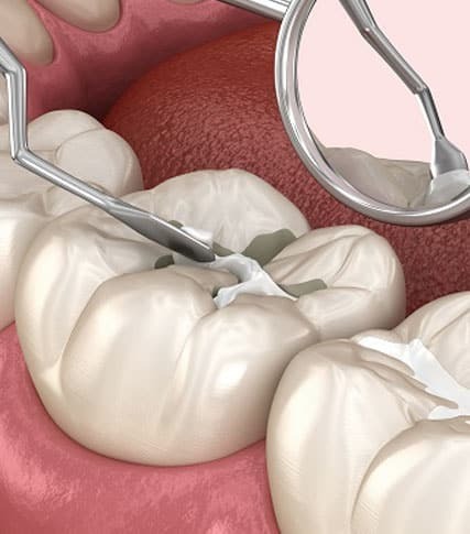 grooves in permanent molars