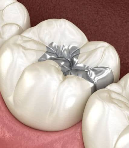 PEDIATRIC SEALANTS