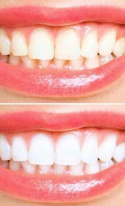 Teeth-whitening