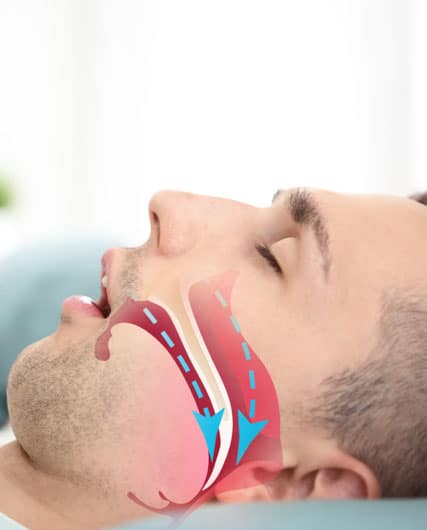 sleep apena