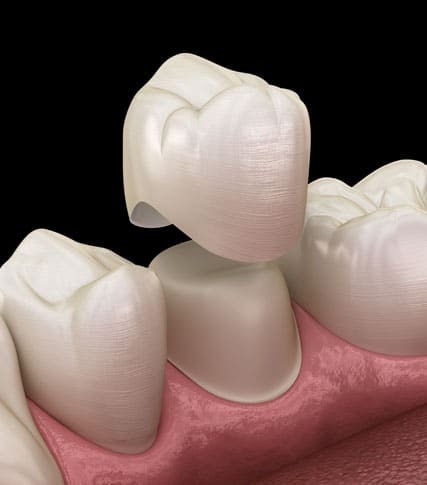 Dental CROWN