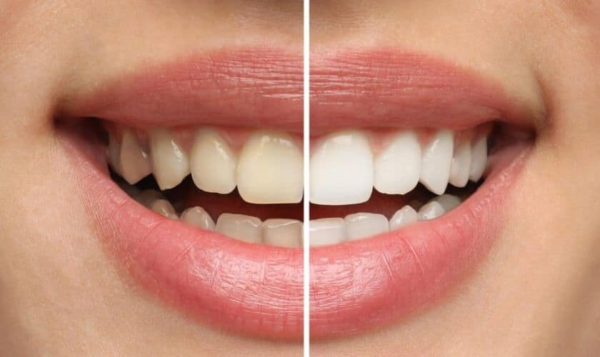 The Science Behind Teeth Whitening: How It Works and What to Expect - Karr & Hardee