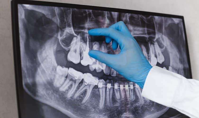 Alternatives to dental implants