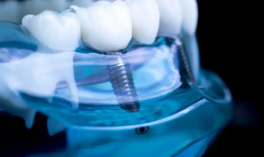 Featured image for “How Dental Implants Can Restore Your Bite and Smile”