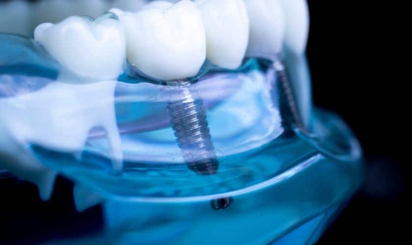 dental implants for bite restoration