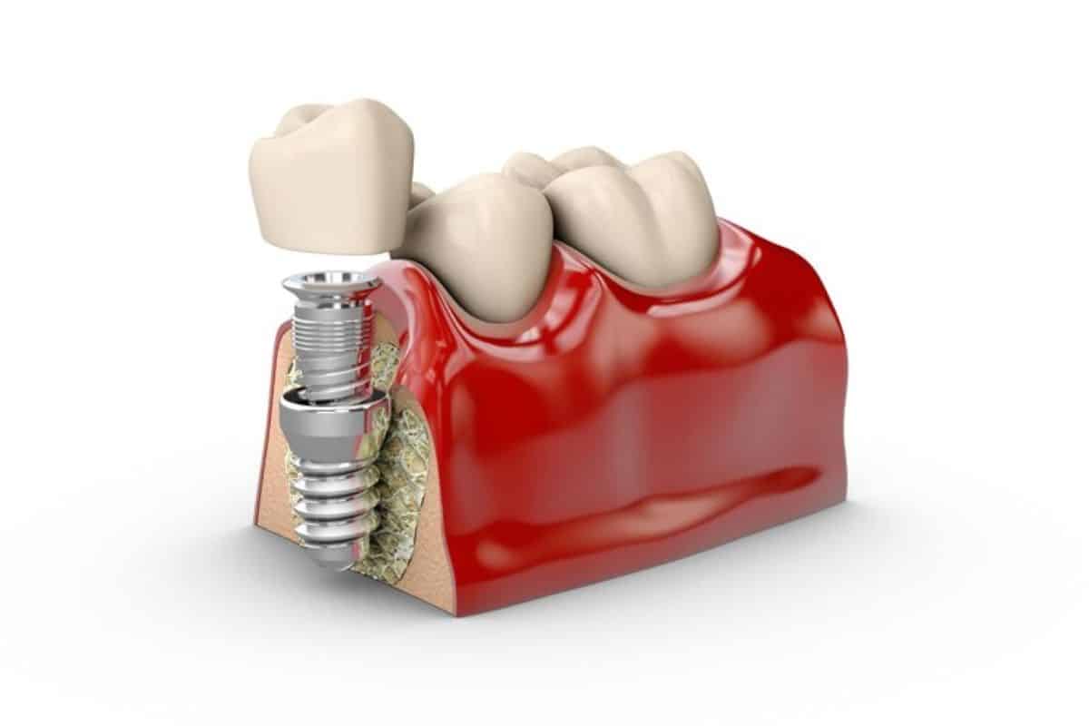 What Not To Do Before Dental Implants