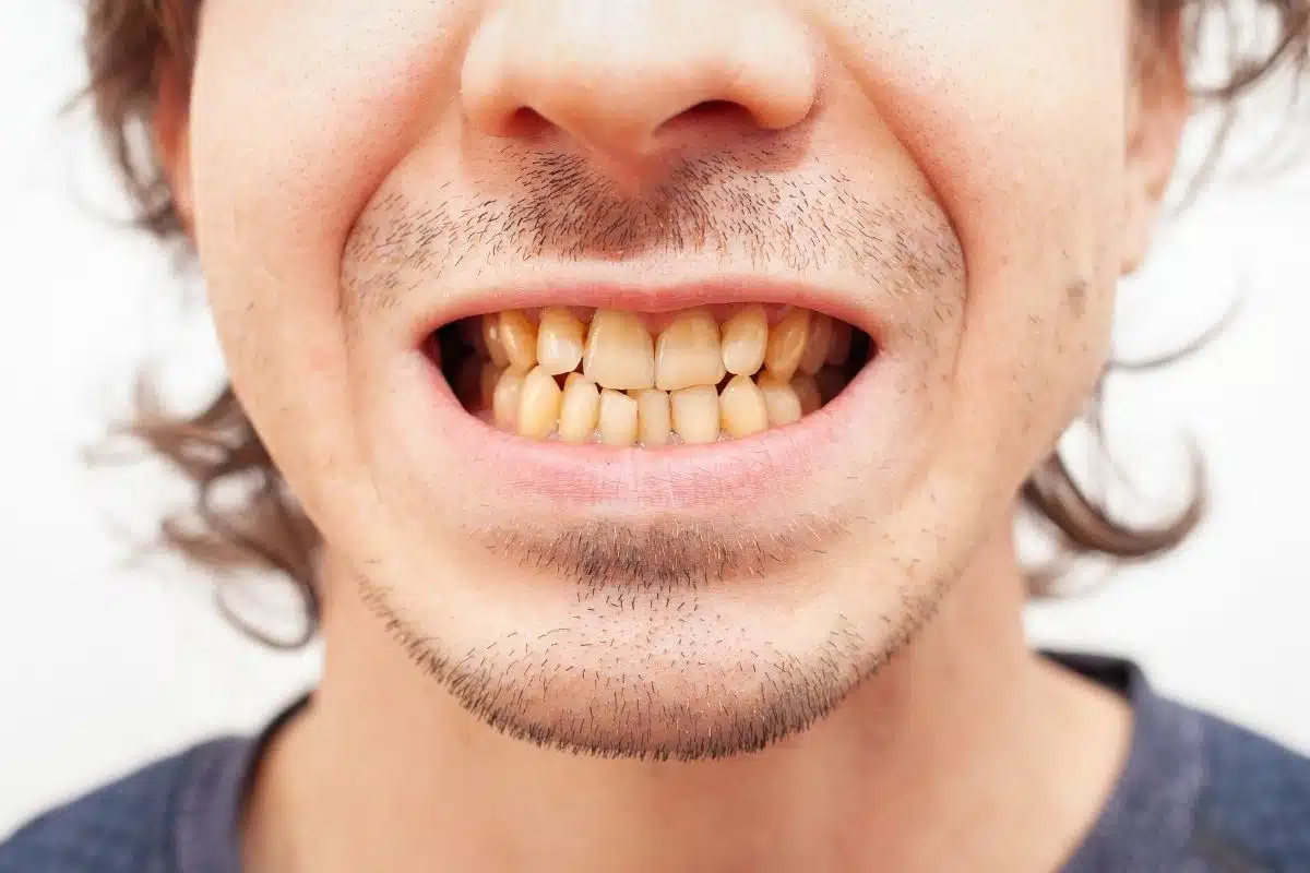 Featured image for “How Dirty Can Teeth Get If You Skip Cleanings?”