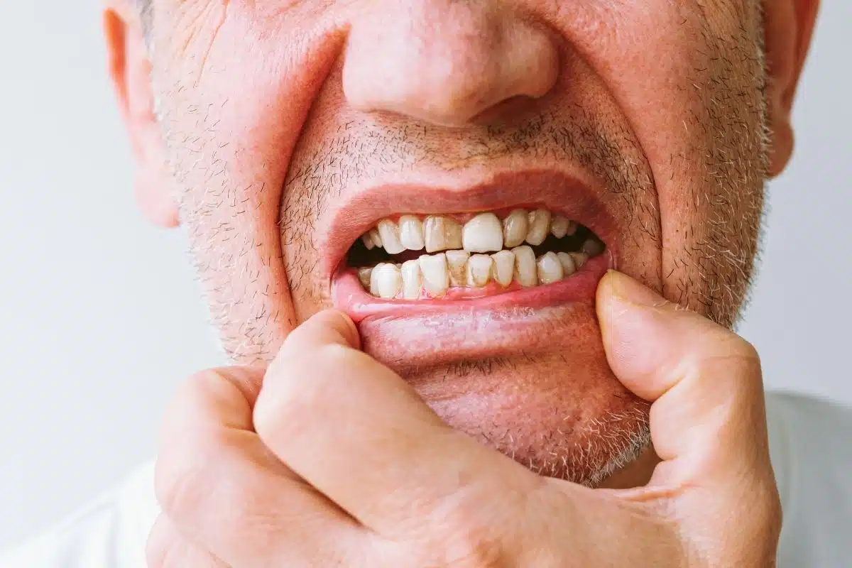 Featured image for “How Do Dentists Restore Damaged Teeth?”