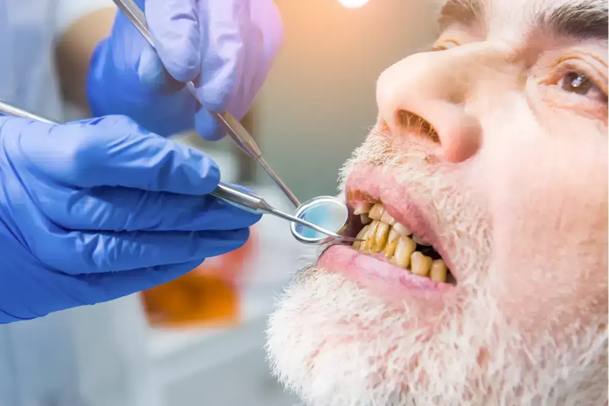 Featured image for “What Happens When You Lose Bone After Tooth Extraction?”
