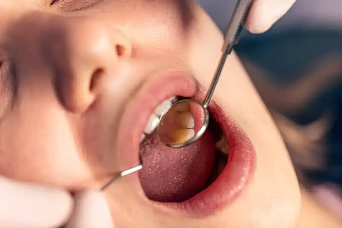 Featured image for “Why Do I Keep Getting Cavities Even Though I Brush Every Day?”