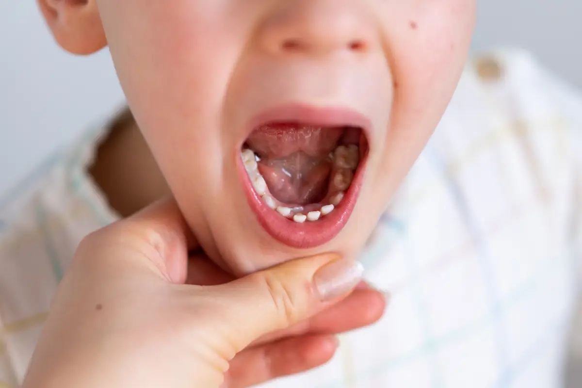 Featured image for “Dental Sealants for Kids: Are They Really Necessary?”